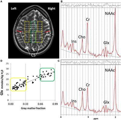 Risk-Conferring Glutamatergic Genes and Brain Glutamate Plus Glutamine in Schizophrenia